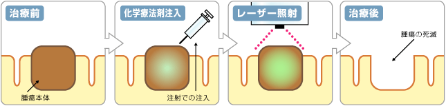 温熱療法イラスト